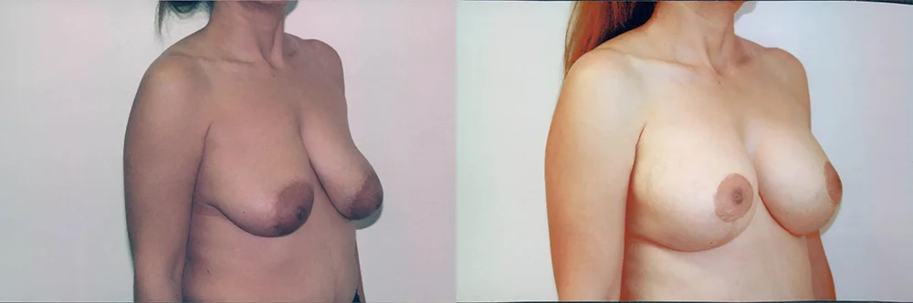 Real patient results in Newport Beach, CA Performed by Boris M. Ackerman MD