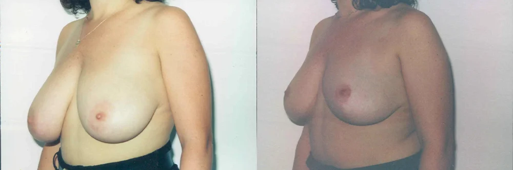 Real patient results in Newport Beach, CA Performed by Boris M. Ackerman MD