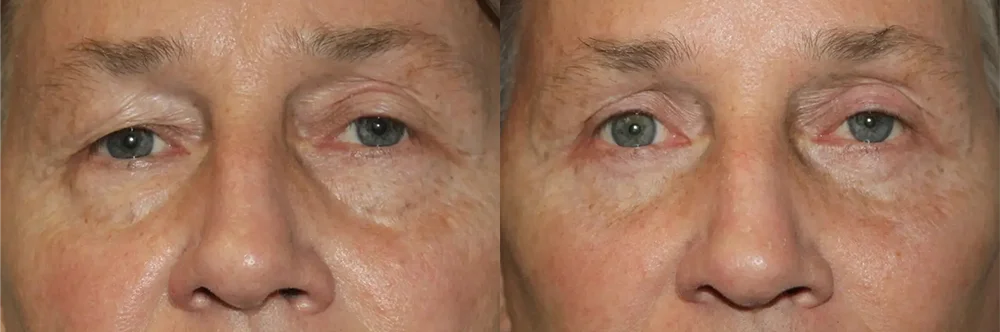 Real patient results in Newport Beach, CA Performed by Boris M. Ackerman MD