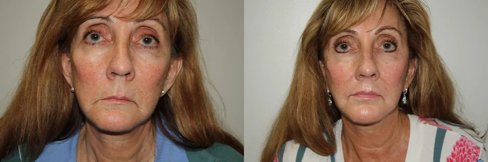 Real patient results in Newport Beach, CA Performed by Boris M. Ackerman MD