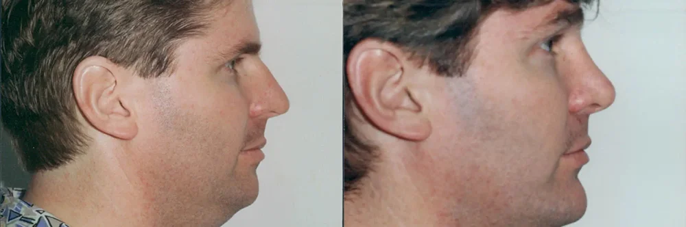 Real patient results in Newport Beach, CA Performed by Boris M. Ackerman MD