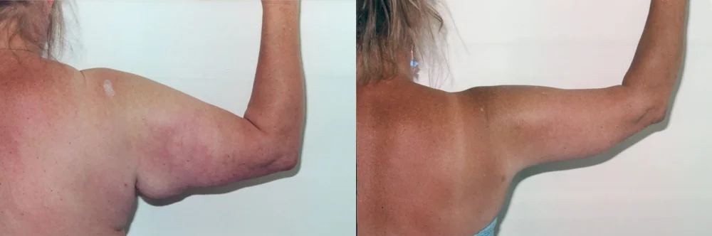 Real patient results in Newport Beach, CA Performed by Boris M. Ackerman MD