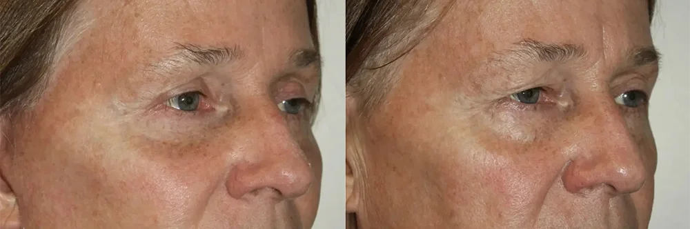 Real patient results in Newport Beach, CA Performed by Boris M. Ackerman MD