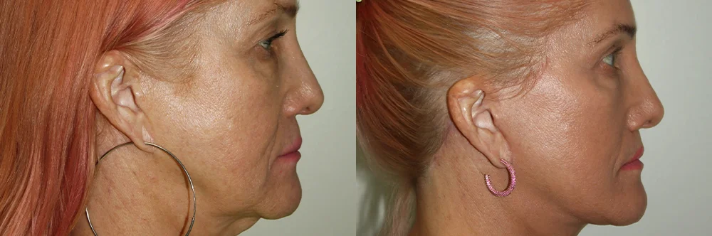 Real patient results in Newport Beach, CA Performed by Boris M. Ackerman MD