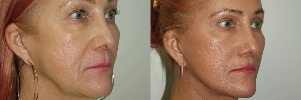 Real patient results in Newport Beach, CA Performed by Boris M. Ackerman MD