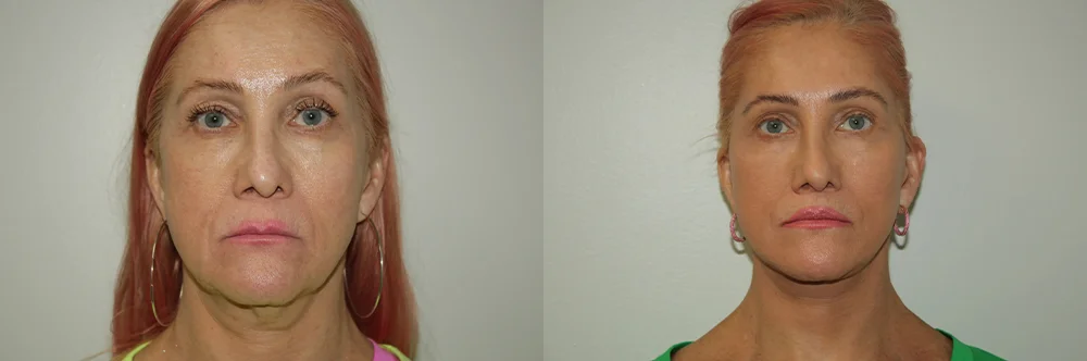 Real patient results in Newport Beach, CA Performed by Boris M. Ackerman MD