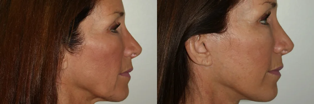 Real patient results in Newport Beach, CA Performed by Boris M. Ackerman MD