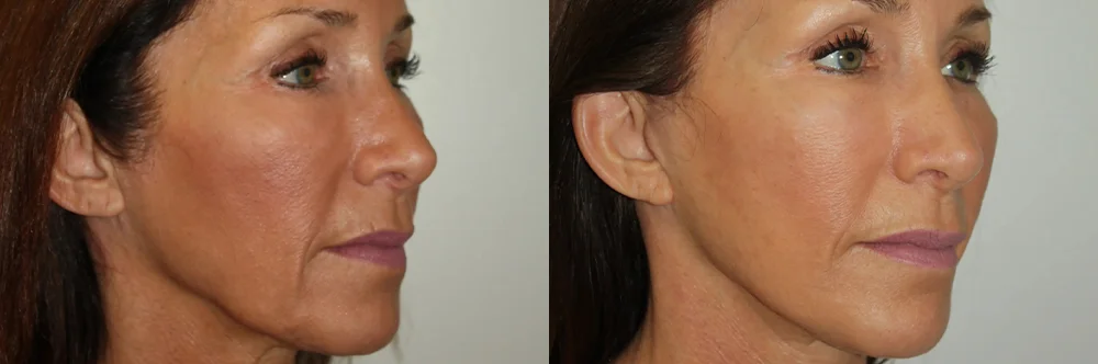 Real patient results in Newport Beach, CA Performed by Boris M. Ackerman MD