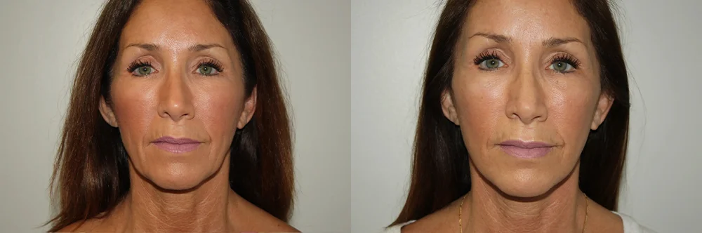 Real patient results in Newport Beach, CA Performed by Boris M. Ackerman MD