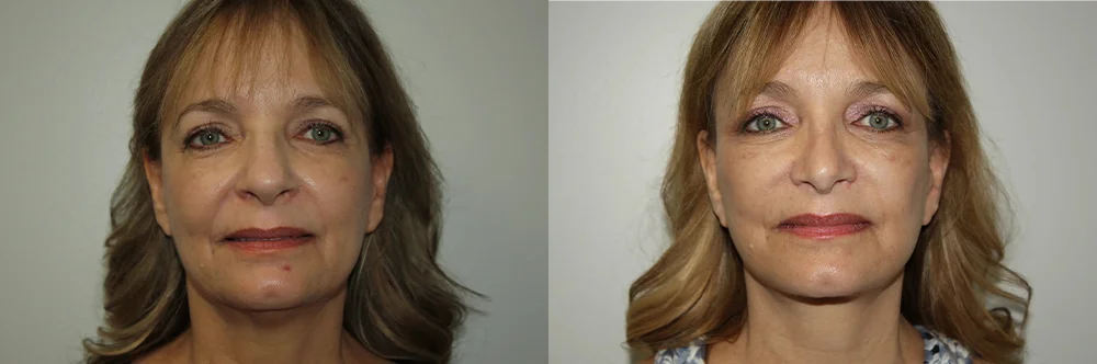 Real patient results in Newport Beach, CA Performed by Boris M. Ackerman MD
