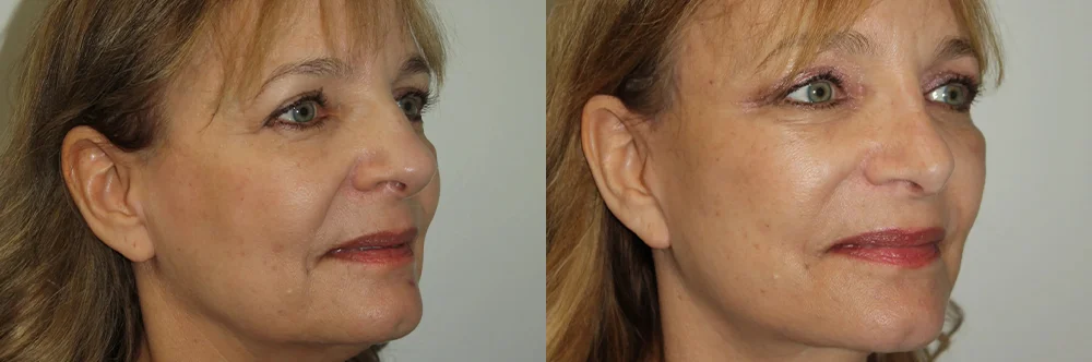 Real patient results in Newport Beach, CA Performed by Boris M. Ackerman MD