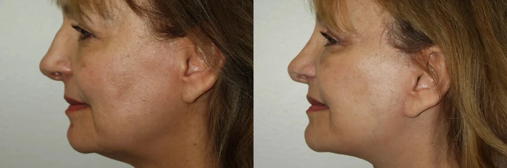 Real patient results in Newport Beach, CA Performed by Boris M. Ackerman MD