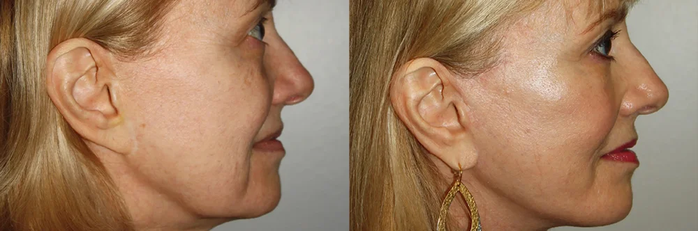 Real patient results in Newport Beach, CA Performed by Boris M. Ackerman MD