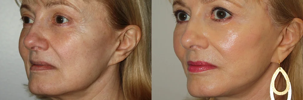 Real patient results in Newport Beach, CA Performed by Boris M. Ackerman MD