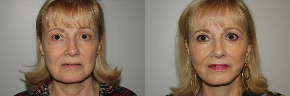 Real patient results in Newport Beach, CA Performed by Boris M. Ackerman MD