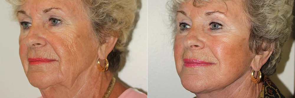Real patient results in Newport Beach, CA Performed by Boris M. Ackerman MD