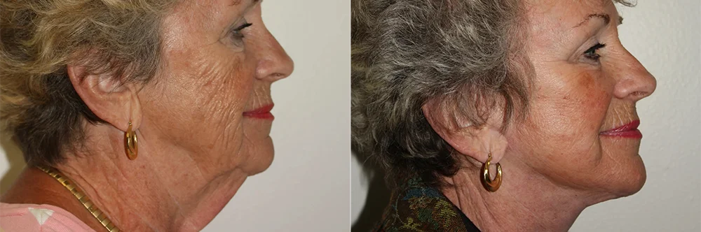 Real patient results in Newport Beach, CA Performed by Boris M. Ackerman MD