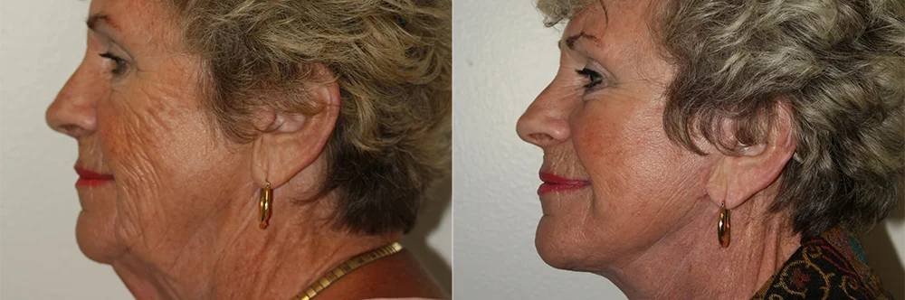 Real patient results in Newport Beach, CA Performed by Boris M. Ackerman MD