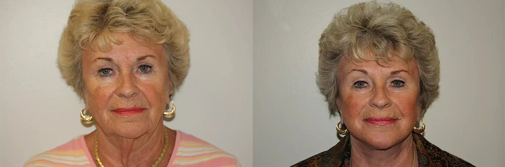 Real patient results in Newport Beach, CA Performed by Boris M. Ackerman MD