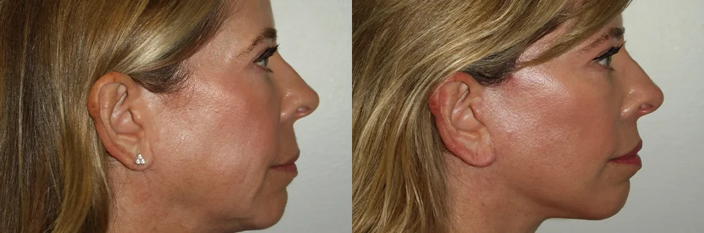 Real patient results in Newport Beach, CA Performed by Boris M. Ackerman MD