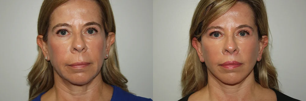 Real patient results in Newport Beach, CA Performed by Boris M. Ackerman MD