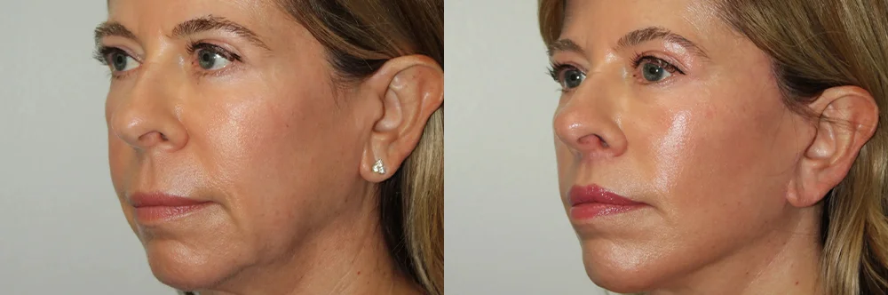 Real patient results in Newport Beach, CA Performed by Boris M. Ackerman MD