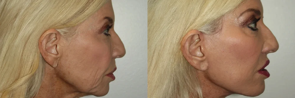 Real patient results in Newport Beach, CA Performed by Boris M. Ackerman MD