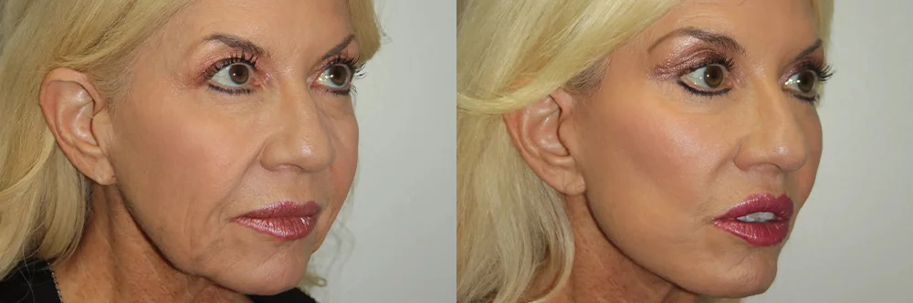 Real patient results in Newport Beach, CA Performed by Boris M. Ackerman MD