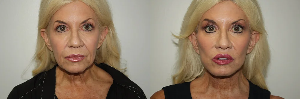 Real patient results in Newport Beach, CA Performed by Boris M. Ackerman MD