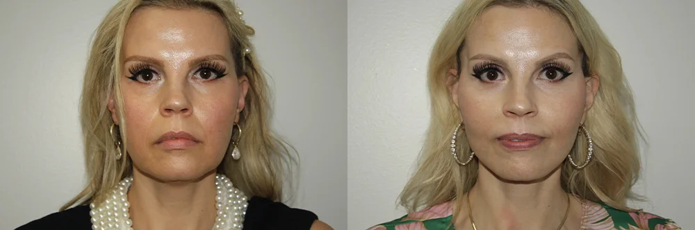 Real patient results in Newport Beach, CA Performed by Boris M. Ackerman MD