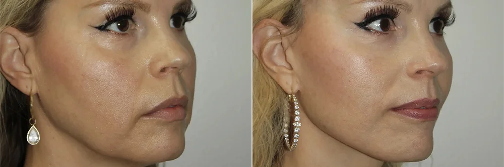 Real patient results in Newport Beach, CA Performed by Boris M. Ackerman MD