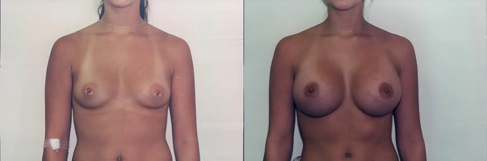 Real patient results in Newport Beach, CA Performed by Boris M. Ackerman MD