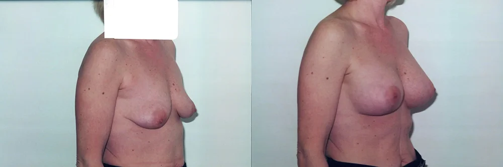 Real patient results in Newport Beach, CA Performed by Boris M. Ackerman MD