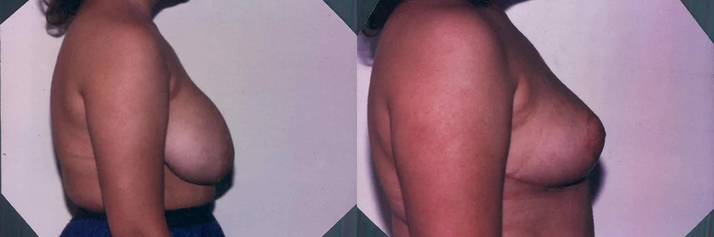 Real patient results in Newport Beach, CA Performed by Boris M. Ackerman MD