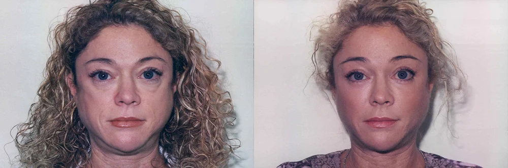 Real patient results in Newport Beach, CA Performed by Boris M. Ackerman MD