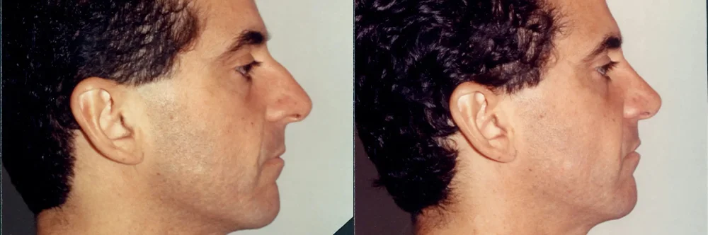 Real patient results in Newport Beach, CA Performed by Boris M. Ackerman MD
