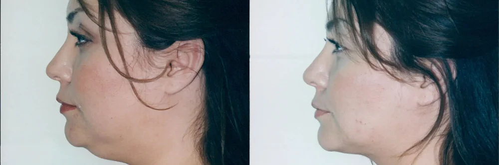 Real patient results in Newport Beach, CA Performed by Boris M. Ackerman MD