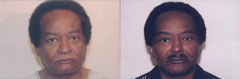 Real patient results in Newport Beach, CA Performed by Boris M. Ackerman MD