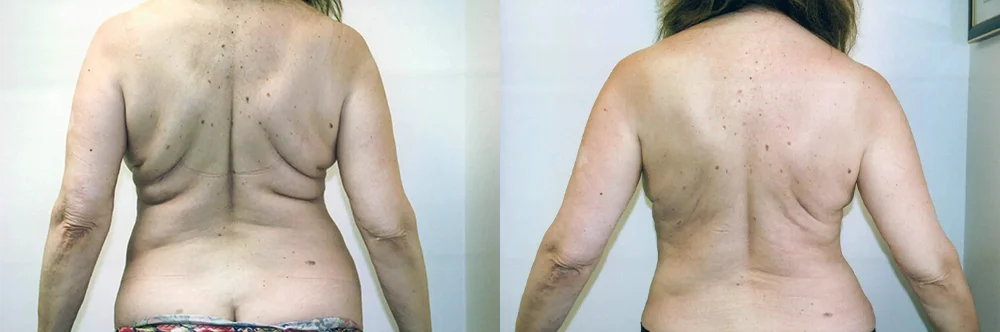 Real patient results in Newport Beach, CA Performed by Boris M. Ackerman MD