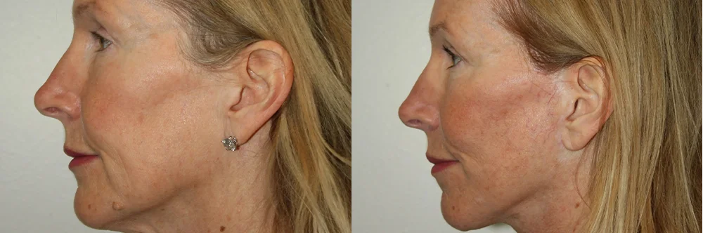 Real patient results in Newport Beach, CA Performed by Boris M. Ackerman MD
