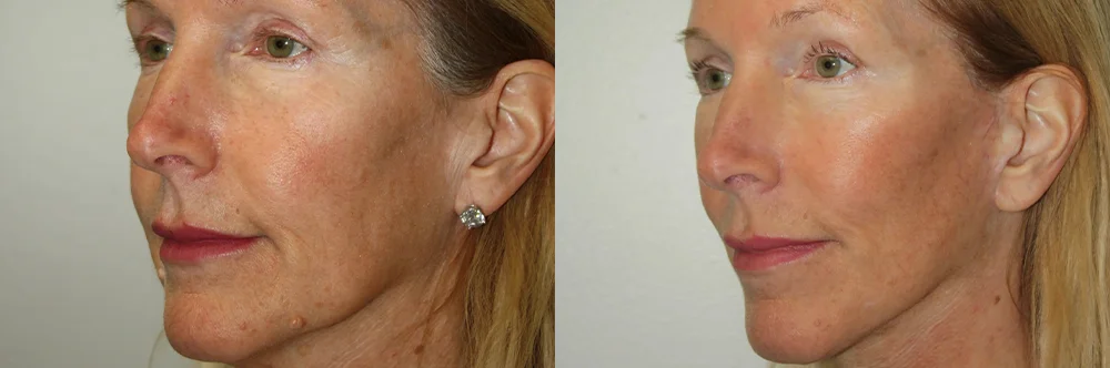 Real patient results in Newport Beach, CA Performed by Boris M. Ackerman MD
