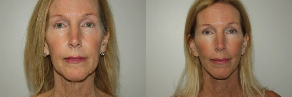 Real patient results in Newport Beach, CA Performed by Boris M. Ackerman MD