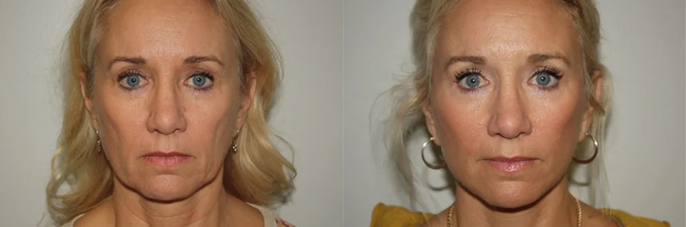 Real patient results in Newport Beach, CA Performed by Boris M. Ackerman MD