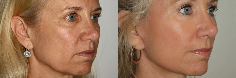 Real patient results in Newport Beach, CA Performed by Boris M. Ackerman MD
