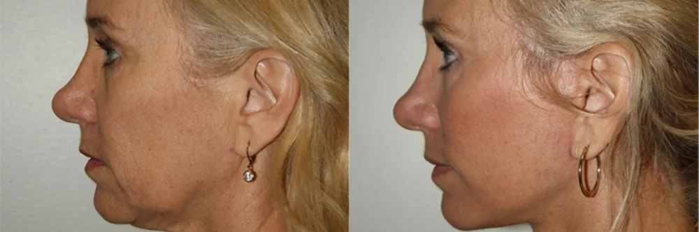 Real patient results in Newport Beach, CA Performed by Boris M. Ackerman MD