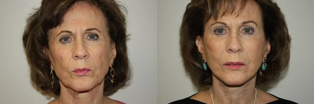 Real patient results in Newport Beach, CA Performed by Boris M. Ackerman MD