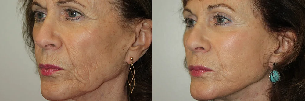 Real patient results in Newport Beach, CA Performed by Boris M. Ackerman MD