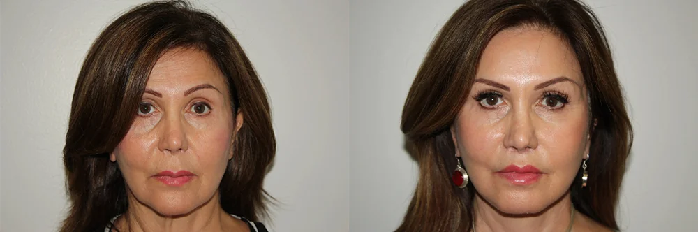 Real patient results in Newport Beach, CA Performed by Boris M. Ackerman MD