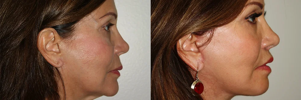 Real patient results in Newport Beach, CA Performed by Boris M. Ackerman MD