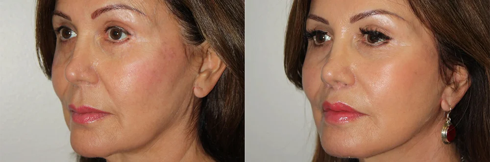 Real patient results in Newport Beach, CA Performed by Boris M. Ackerman MD